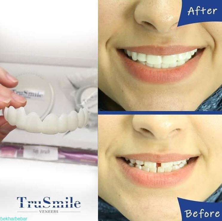 لمینت متحرک دندان 